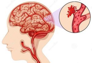 Đột quỵ là gì? 5 thuốc chống đột quỵ của nhật bản và hàn quốc tốt nhất! 2