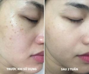 Công dụng của Eucerin trị nám