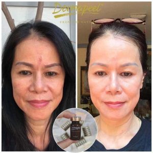 Review vi kim tảo biển Dermapeel của khách hàng