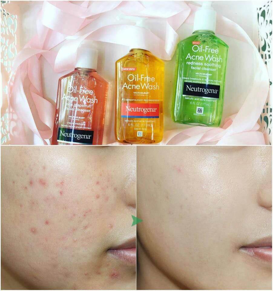 REVIEW Sữa Rữa Mặt Kiềm Dầu Neutrogena Oil Free Acne Wash 2