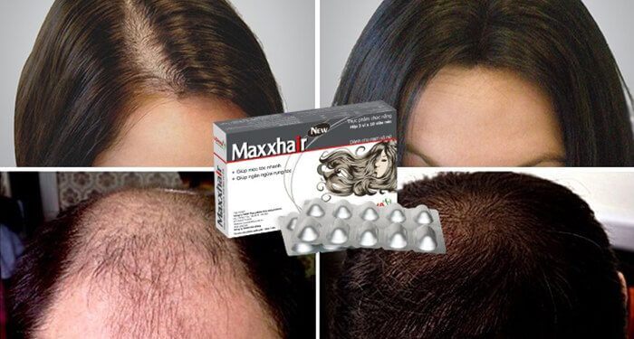 Thành phần thuốc trị rụng tóc Maxxhair