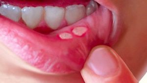 Nhiệt miệng do vi khuẩn HSV-1 gây ra
