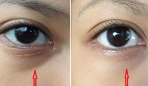 cách làm hết thâm quầng mắt